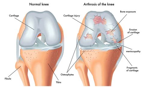 Knee Pain & Osteoarthritis – Amy Chen Registered Physiotherapist