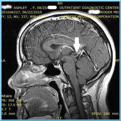 What is a Pineal Cyst - Arthritic Chick