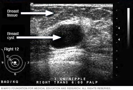 Ultrasound - Mayo Clinic