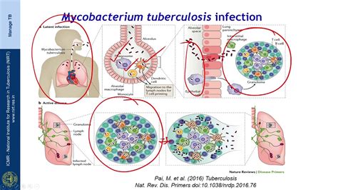 Tuberculosis Pathogenesis Flowchart