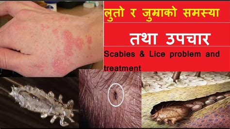 लुतो र जुम्राको समस्या तथा उपचार ,Scabies & Lice problem and treatment || by dr kalyan - YouTube