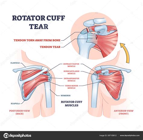 Awesome Disillusion expiration rotator cuff labeled semester surprise Shrug shoulders