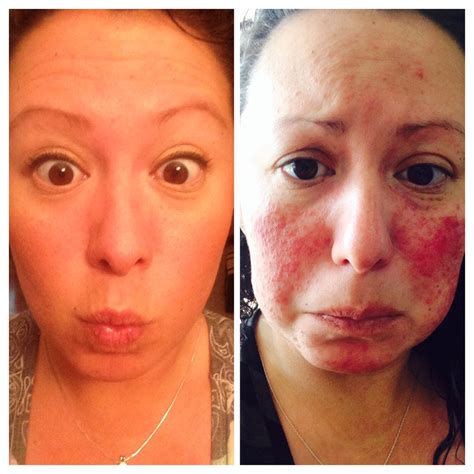 Before and after pic just only 4 weeks of progress into getting my Rosacea un... | Rebrn.com