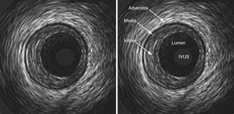 Intravascular Ultrasound | Radiology Key