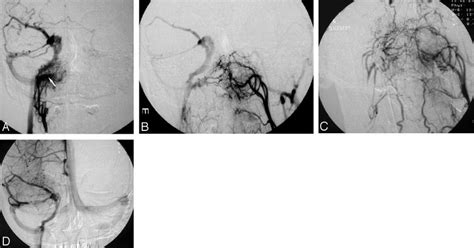 Case 1. A, Right ascending pharyngeal artery angiogram in AP view: DAVS... | Download Scientific ...