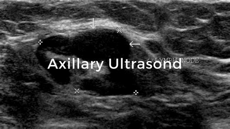 Axillary Ultrasound: Breast Cancer School for Patients