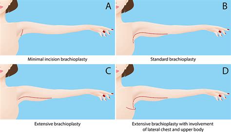 Arm Lift Virginia | Brachioplasty Washington D.C. and Maryland