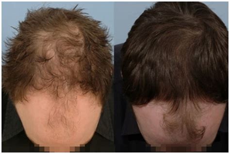 Gallery - Before & After Photos of Hair Loss Treatment - HRBR, UK