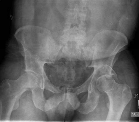 Acetabular Fractures Trauma Orthobullets