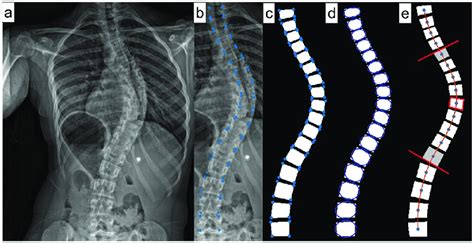 Steps of Cobb angle measurement from frontal radiographs. a. Plain... | Download Scientific Diagram