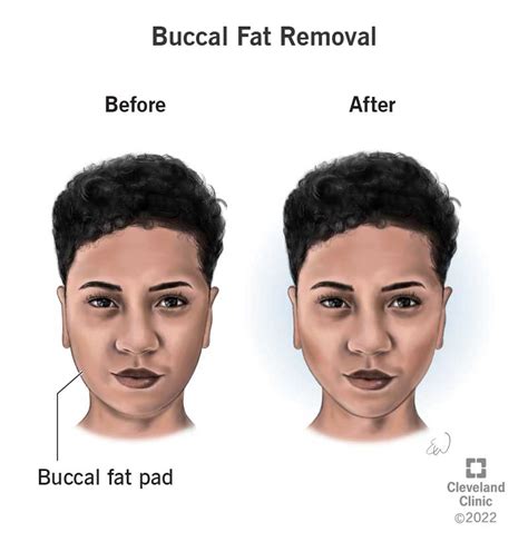 Buccal Fat Removal: What It Is, Recovery & Before & After