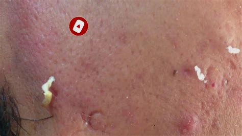 |Blackheads Extraction| |Blackheads Removal| |dr pimple popper office| - YouTube