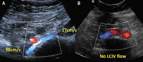 Diagnosis of Iliac Vein Obstruction With Duplex Ultrasound - Endovascular Today