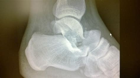 Talar Neck Fractures - Trauma - Orthobullets.com