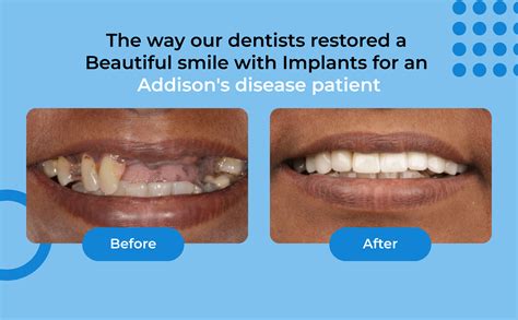 Smile restoration with implants for an Addison's disease patient