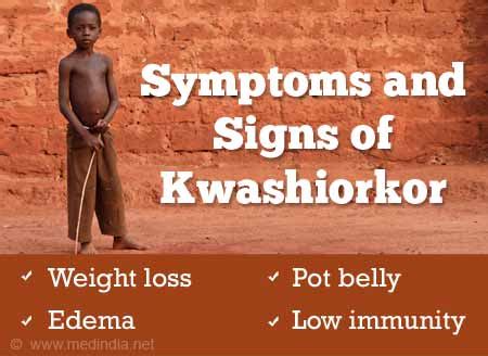 Marvelous Info About How To Prevent Kwashiorkor - Fewcontent