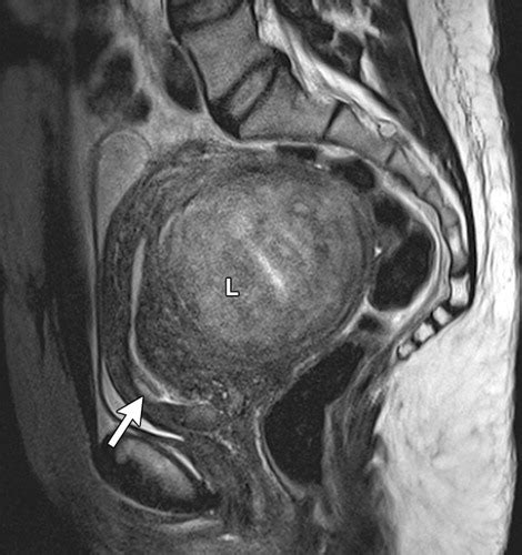 Role of MR Imaging of Uterine Leiomyomas before and after Embolization ...