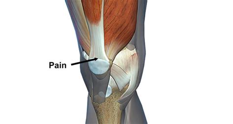 Quadriceps Tendonitis (Tendinopathy) - Sportsinjuryclinic.net