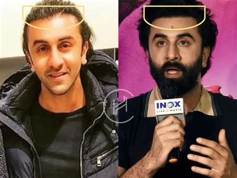 Ranbir Kapoor Hair Transplant - Hair Loss & Technical Analysis