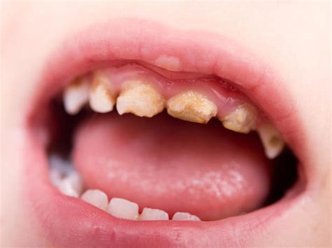 Tooth decay in children costing the NHS more than £40m a year, figures show | The Independent ...