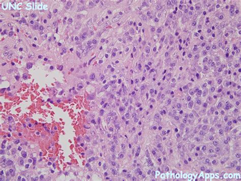 angiomatoid fibrous histiocytoma pathology