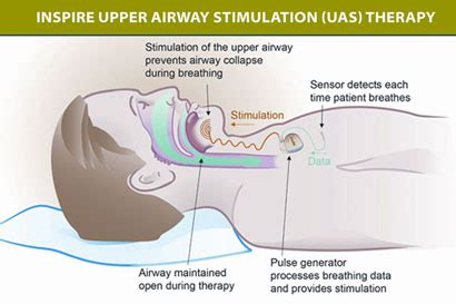 Implanted Inspire Upper Airway Stimulator Significantly Improves OSA - Sleep Review