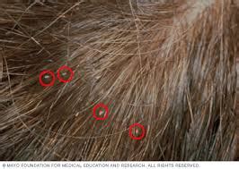 Head Lice – TRSD | School Health Services