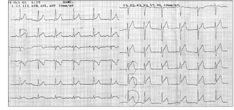 Figure 2 from A Case of Hereditary Antithrombin III Deficiency ...