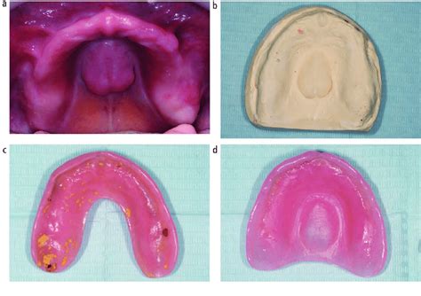 Management of a large palatal torus. a & b) A patient presented with a... | Download Scientific ...