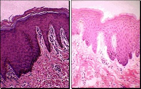 Keratinized Stratified Squamous Epithelium - Anyatrust