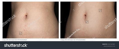 Before After Picture Showing Progress Skin Stock Photo 1827427007 | Shutterstock