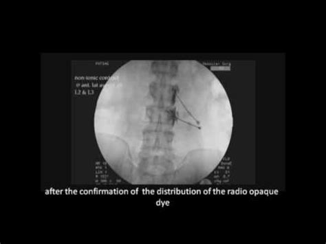 Lumbar sympathectomy final video - YouTube