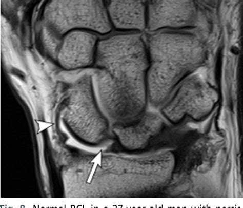 Figure 8 from MR Imaging of Wrist Ligaments. | Semantic Scholar