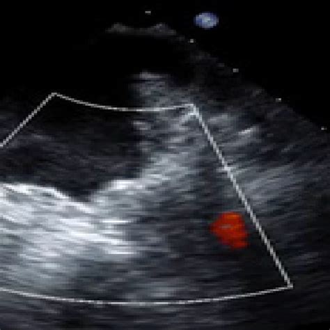 This figure confirms a large thrombus in the left atrial appendage on ...