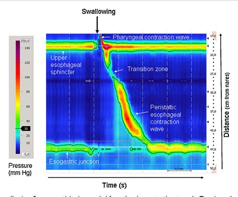 Figure 4 from High-resolution manometry: a new gold standard to diagnose esophageal dysmotility ...