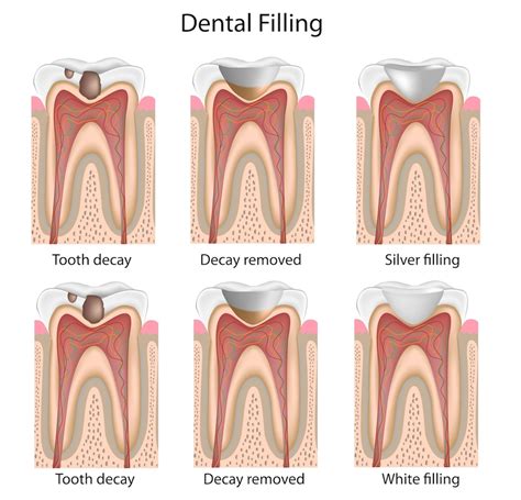 Clinica Dental, Dentistas en Tijuana Mexico | Dentist in Tijuana Centro | Implantes Dentales ...