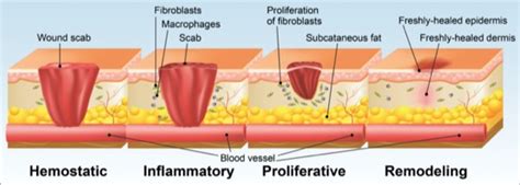 The Importance of Adequate Debridement