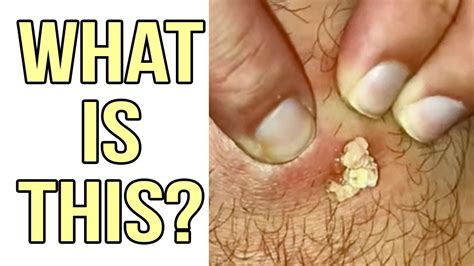 What Are Epidermoid Cysts? Amazing Examples with Explanation - YouTube