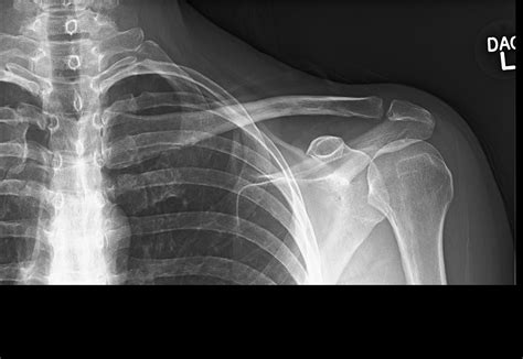 Clavicle Bone Xray