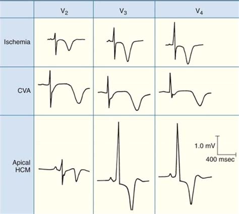 ECG T wave changes and interpretation