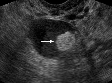 Cystic Teratoma Ultrasound