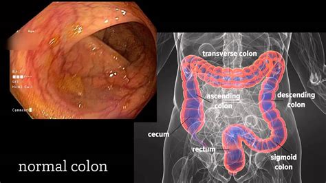 [DIAGRAM] Colon Polyps Diagram - MYDIAGRAM.ONLINE