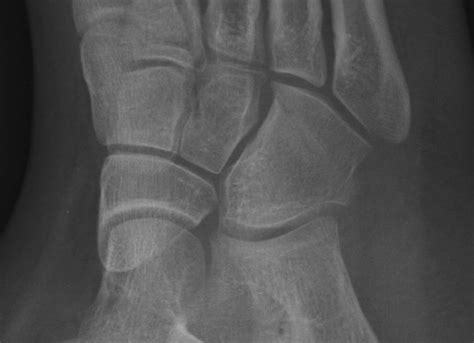 Daily Dose: cuboid fracture