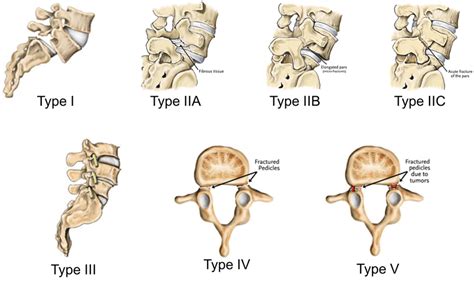 Spondylolisthesis can cause back pain and leg pain.