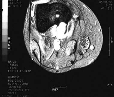 Juxtacortical Tumors: Background, Periosteal Chondroma, Periosteal Chondrosarcoma