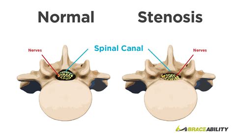 Spine Anatomy Spinal Stenosis