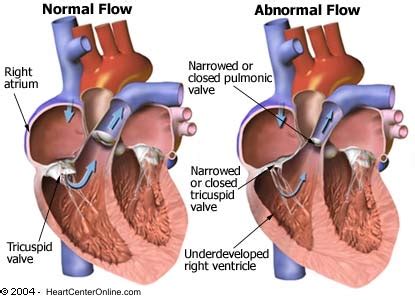 Hypoplastic Right Heart Syndrome - Lily's Heart Warriors