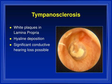 Otitis Externa Tympanic Membrane