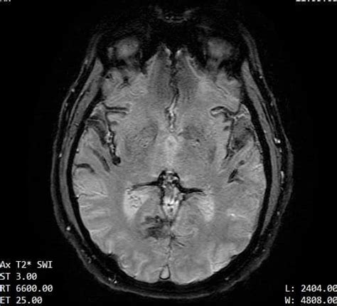 Decoding The Superficial Siderosis MRI