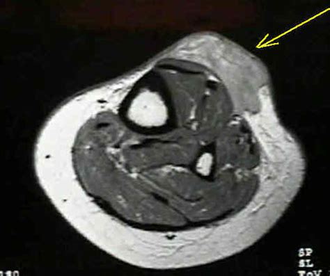 Malignant Fibrous Histiocytoma : Wheeless' Textbook of Orthopaedics